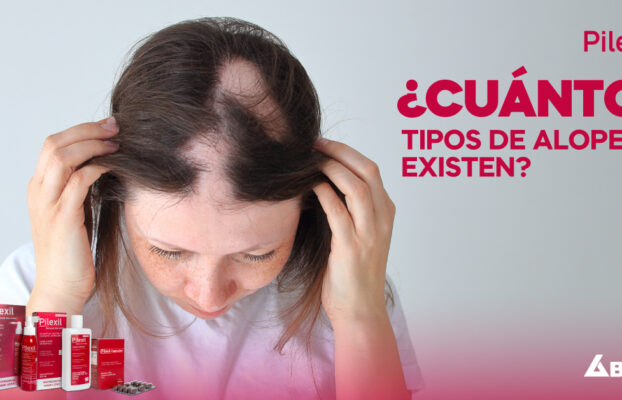 ¿Cuántos tipos de alopecia existen?