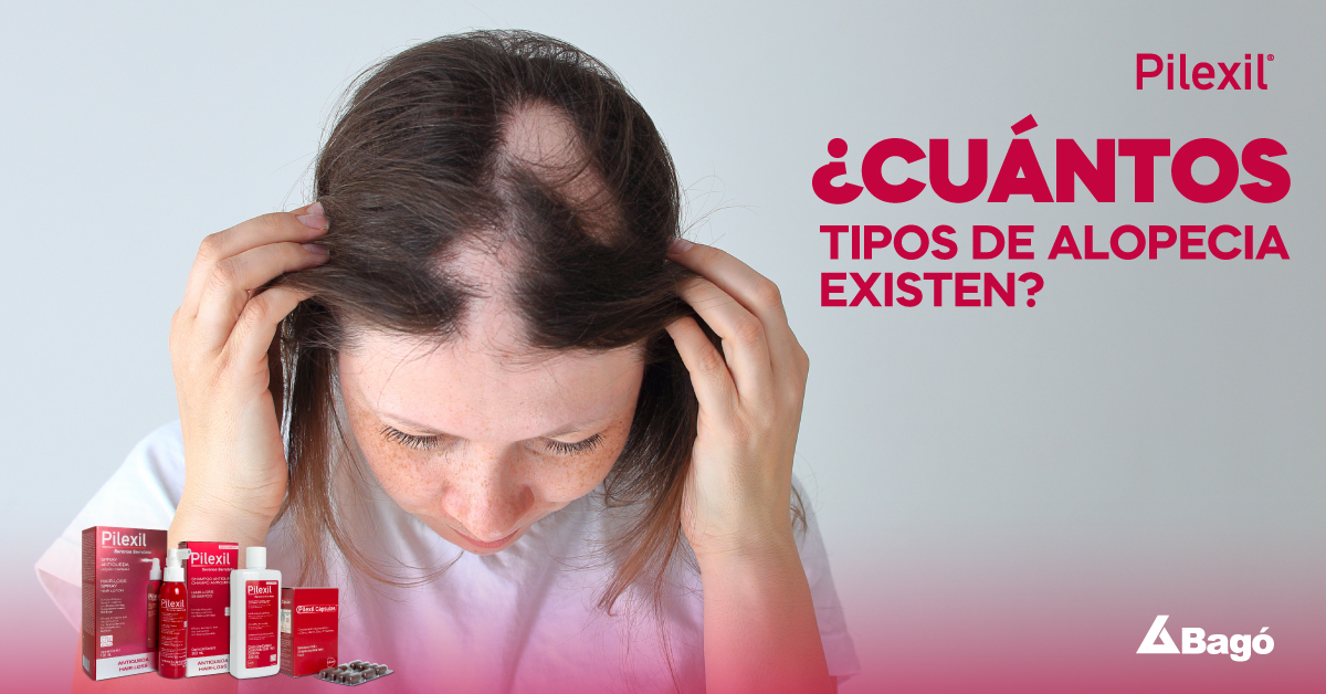 ¿Cuántos tipos de alopecia existen?